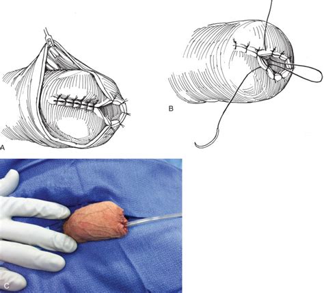 nullo penectomy|@alphanullo .